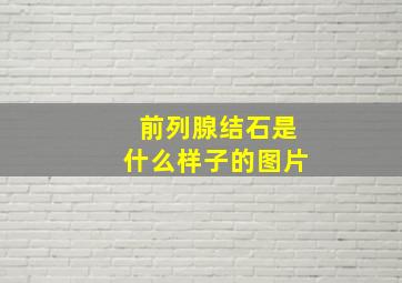 前列腺结石是什么样子的图片