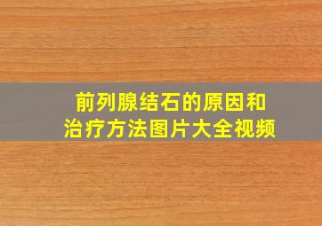 前列腺结石的原因和治疗方法图片大全视频