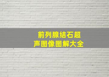 前列腺结石超声图像图解大全