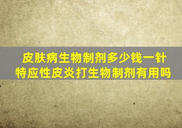 皮肤病生物制剂多少钱一针特应性皮炎打生物制剂有用吗