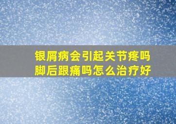 银屑病会引起关节疼吗脚后跟痛吗怎么治疗好