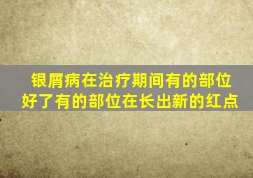 银屑病在治疗期间有的部位好了有的部位在长出新的红点