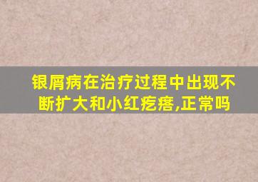 银屑病在治疗过程中出现不断扩大和小红疙瘩,正常吗