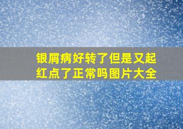 银屑病好转了但是又起红点了正常吗图片大全