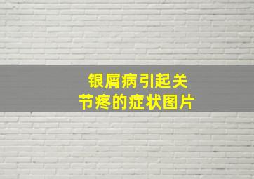 银屑病引起关节疼的症状图片