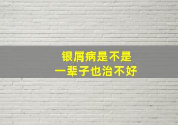 银屑病是不是一辈子也治不好