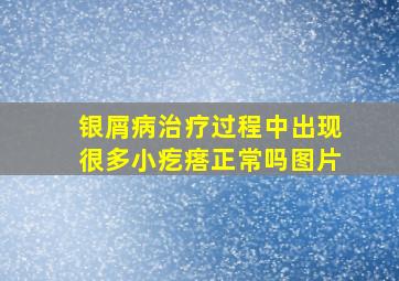 银屑病治疗过程中出现很多小疙瘩正常吗图片