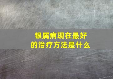 银屑病现在最好的治疗方法是什么