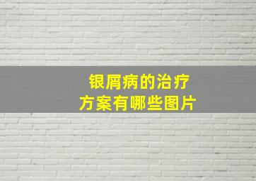 银屑病的治疗方案有哪些图片