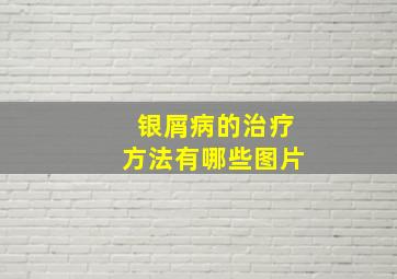 银屑病的治疗方法有哪些图片