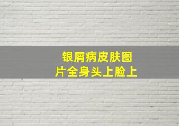 银屑病皮肤图片全身头上脸上