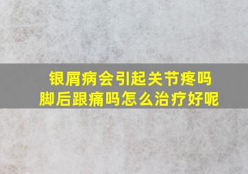 银屑病会引起关节疼吗脚后跟痛吗怎么治疗好呢