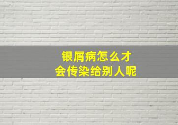 银屑病怎么才会传染给别人呢