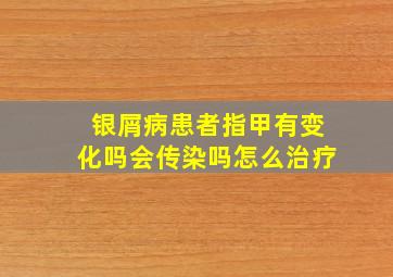 银屑病患者指甲有变化吗会传染吗怎么治疗