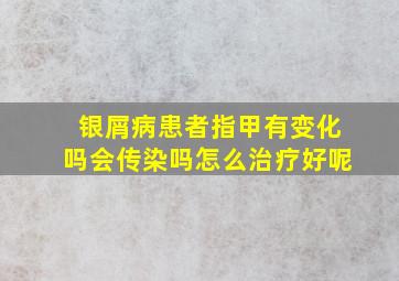 银屑病患者指甲有变化吗会传染吗怎么治疗好呢