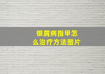 银屑病指甲怎么治疗方法图片